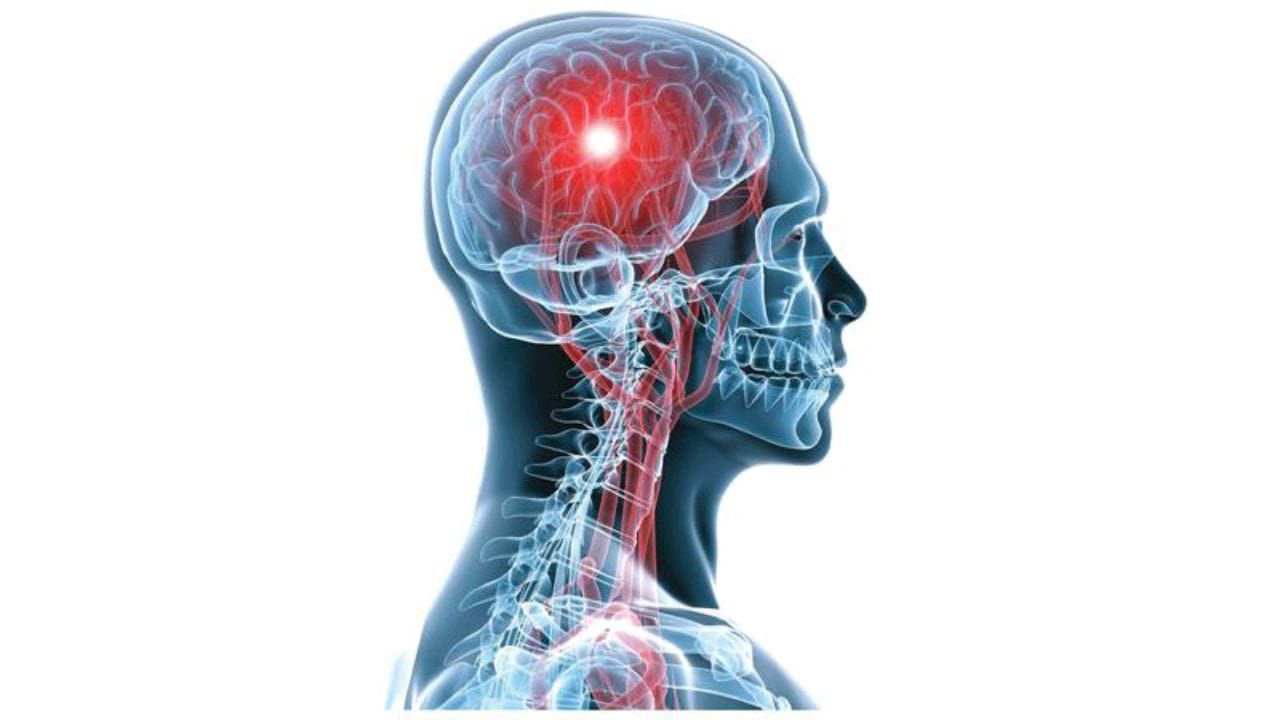 أعراض تمدد الأوعية الدموية الدماغي وعوامل خطورته