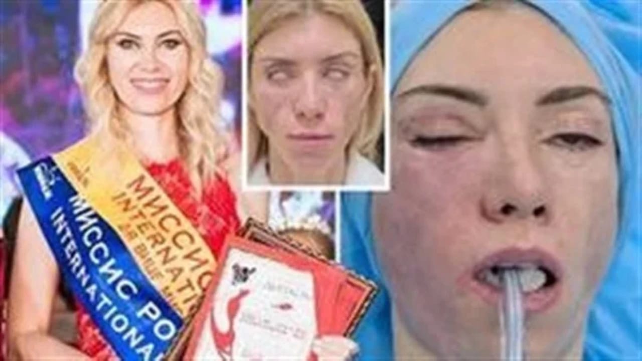 تشوه وجه ملكة جمال روسية بسبب عملية تجميل