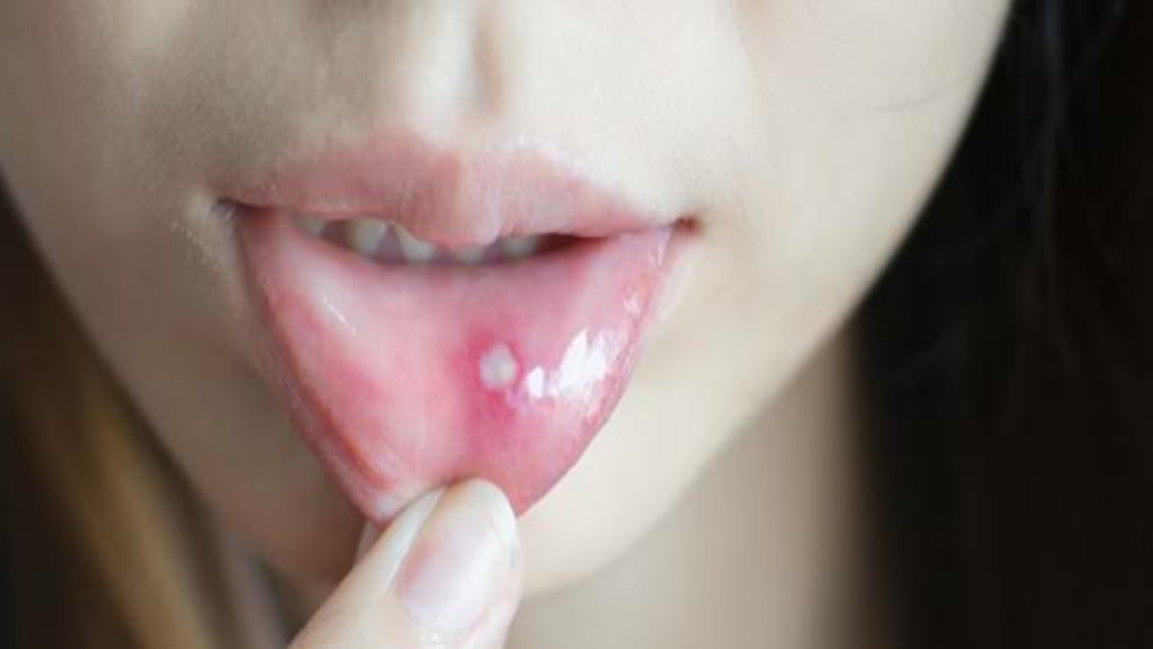 طرق منزلية بسيطة لعلاج تقرحات الفم