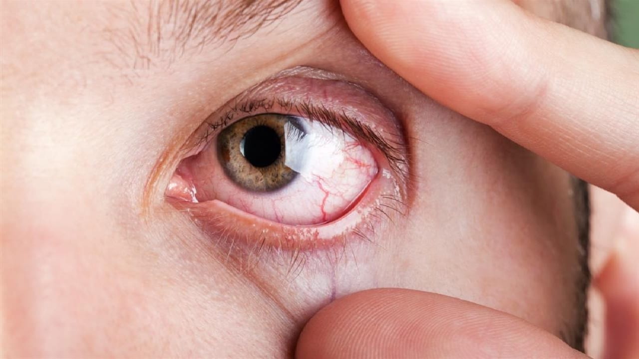 هذه العلامات تنذر بالإصابة بسرطان العين