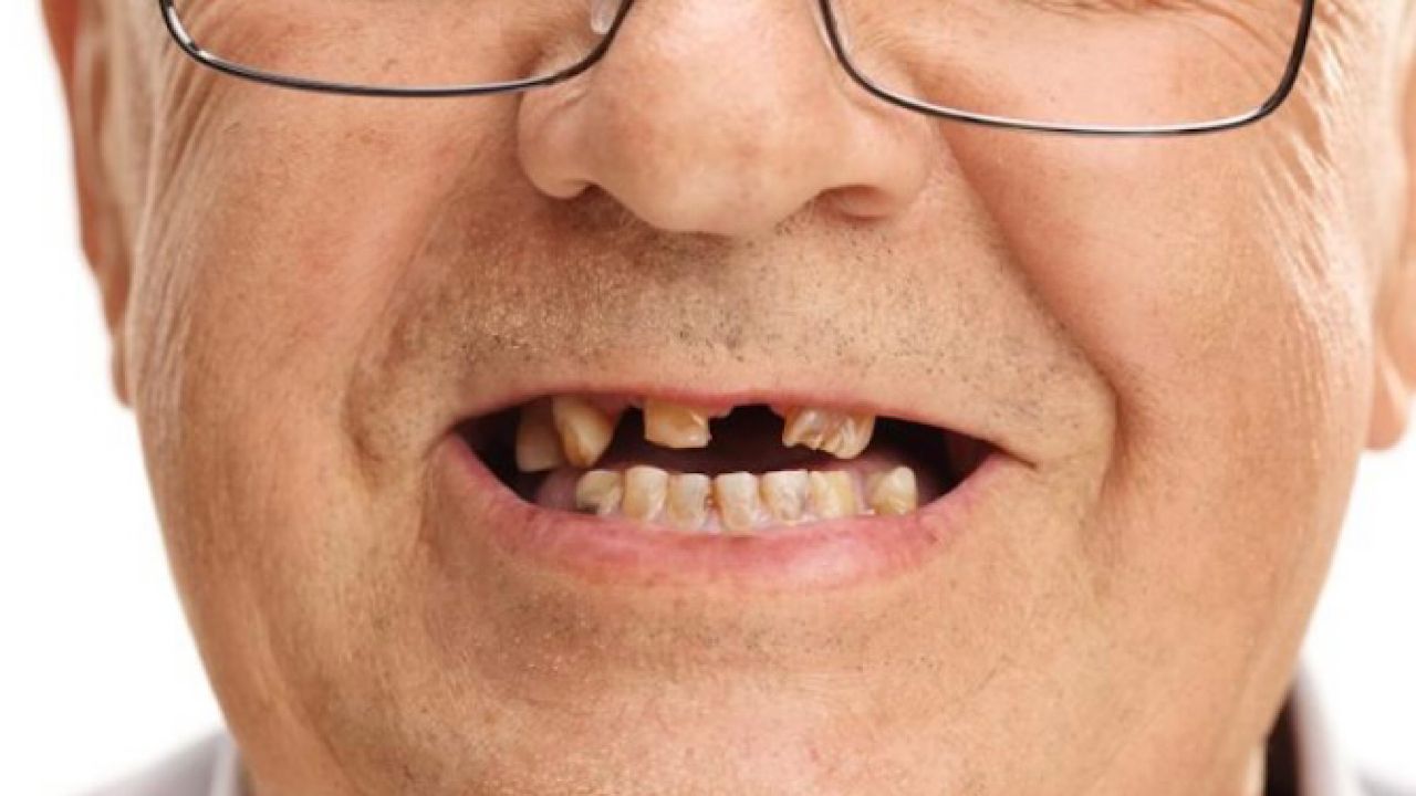 فقدان الأسنان يزيد خطر الإصابة بالسكري لدى كبار السن
