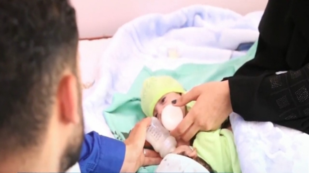 بالفيديو.. أسرة التوأم السيامي اليمني تعلق على توجيهات خادم الحرمين بعلاجهما