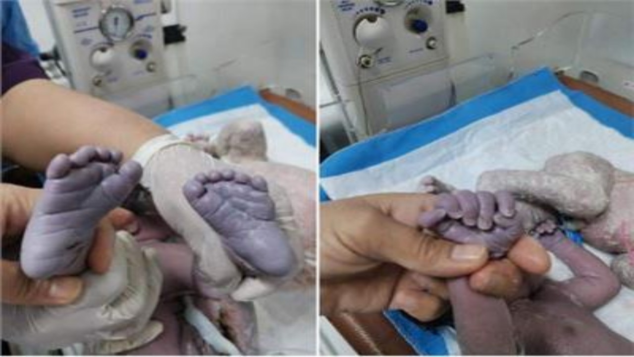 ولادة طفلة بـ 24 إصبعًا