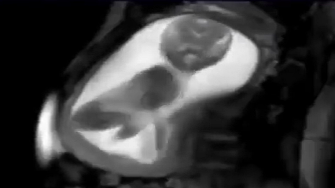 بالفيديو .. رصد حركة جنين داخل رحم أمه في الأشهر الأخيرة من الحمل