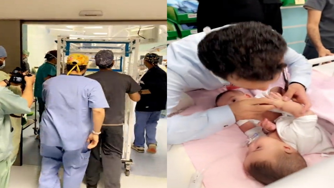 بالفيديو.. التوأم السيامي اليمني يدخلان غرفة العمليات تمهيدًا لفصلهما