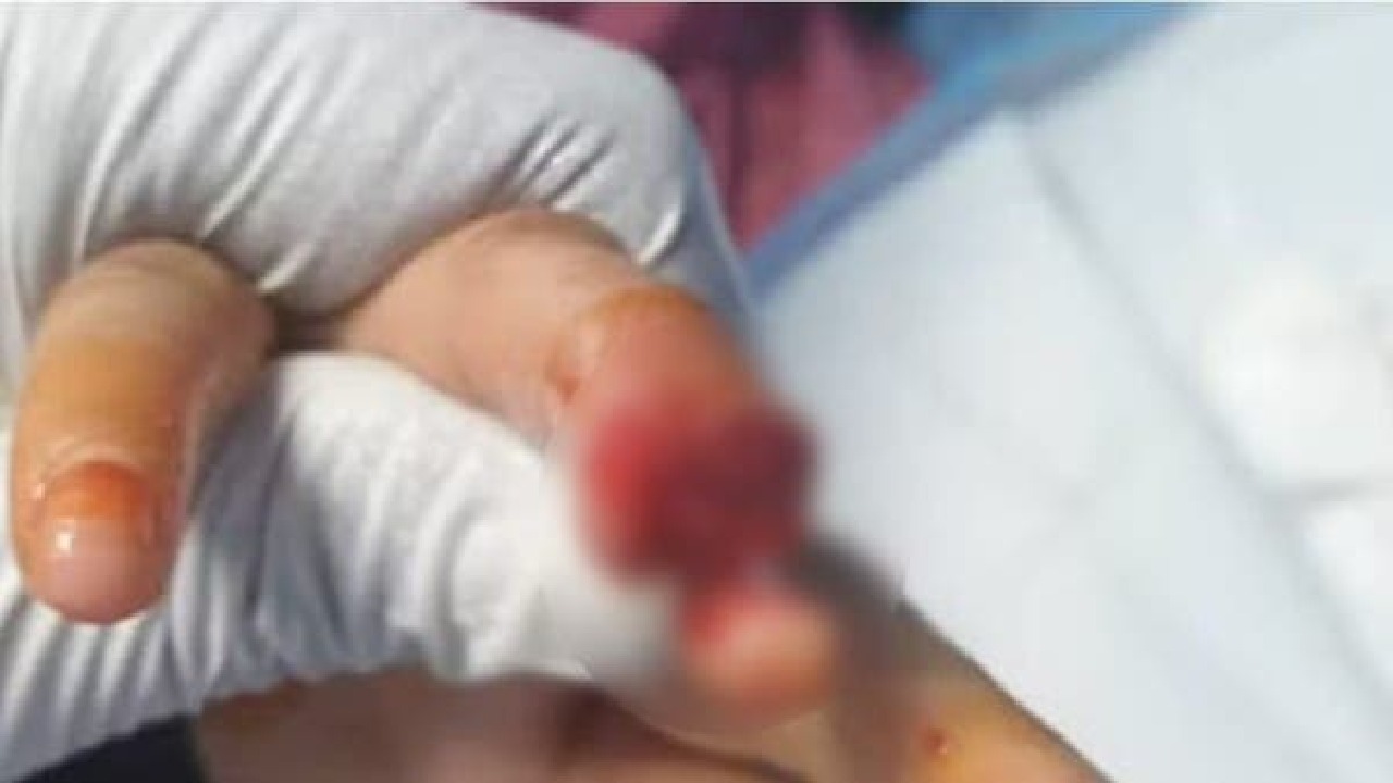 بالفيديو .. تفاصيل جديدة في واقعة بتر جزء من إصبع طالبة بسبب باب الفصل