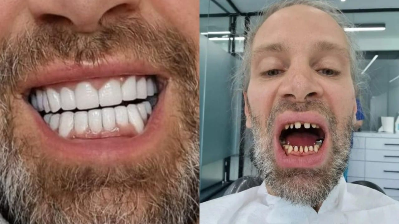 بالصور.. عملية تبييض أسنان تنتهي بتشويه وجه رجل