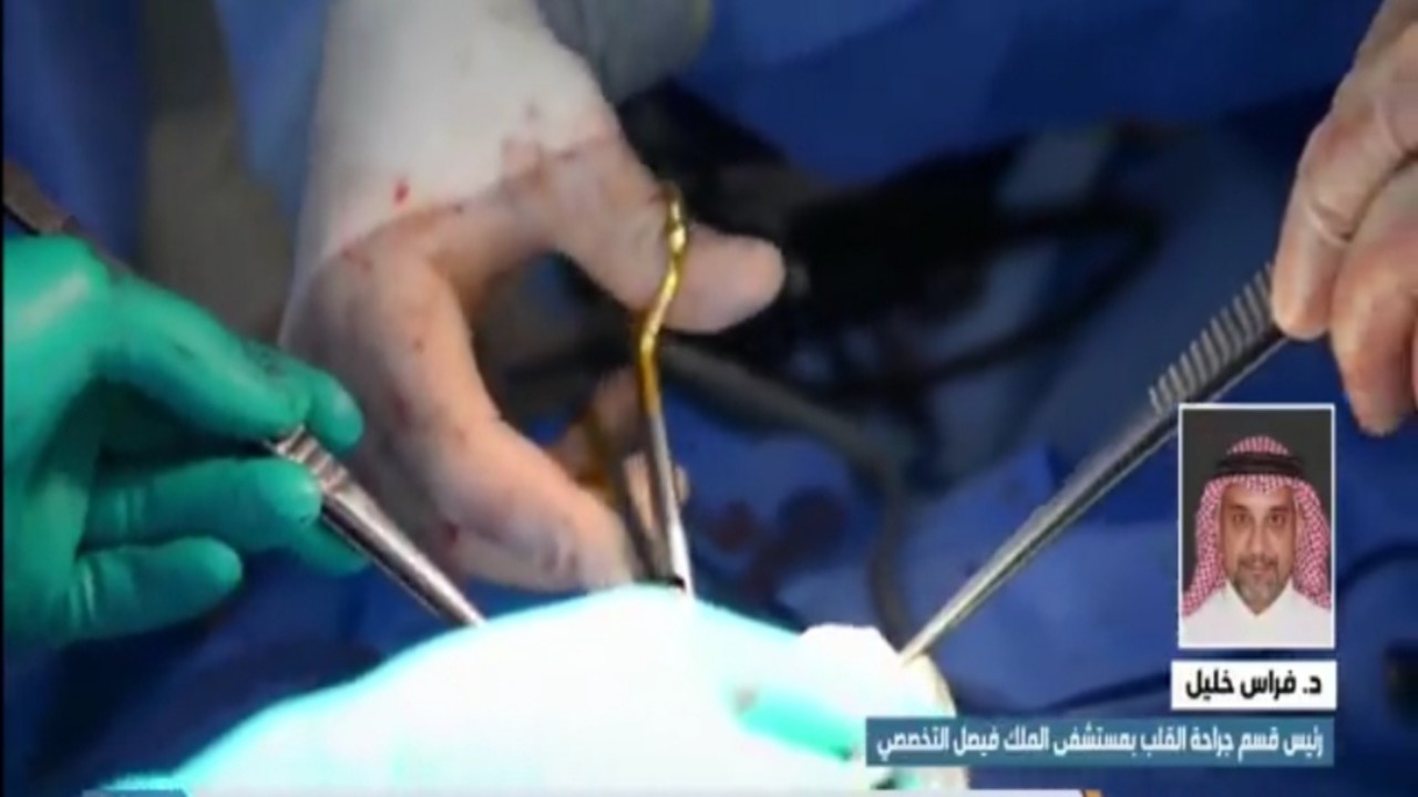 بالفيديو.. نجاح أول عملية لزراعة قلب طبيعي لسيدة كويتية