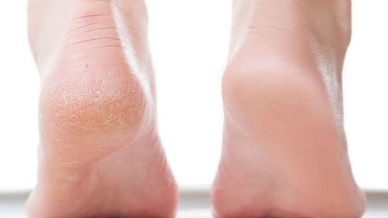 الإصابة بتشقق القدمين قد يكون مؤشرًا للإصابة بمرض خطير