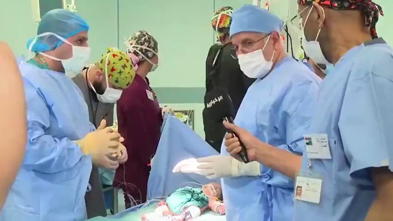 نجاح عملية فصل التوأم السيامي اليمني “سلمان وعبد الله” (فيديو)