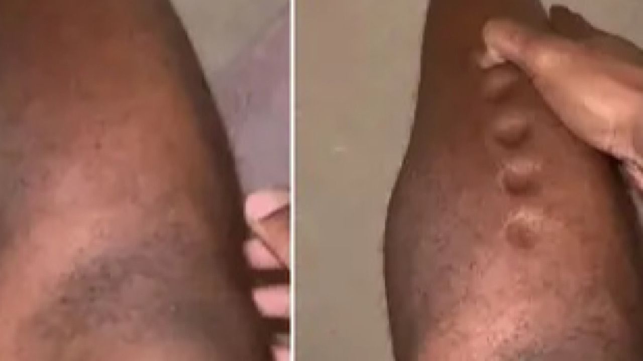 بالفيديو.. رياضي شهير يوثق تحول ساقه إلى عجينة ويكشف عن إصابته بمرض خطير