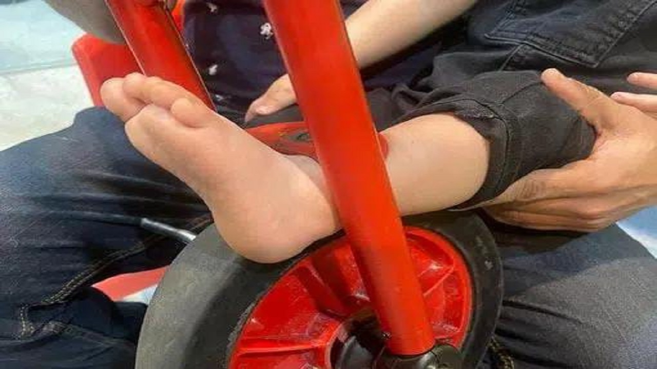 مدني القطيف يحرر قدم طفل علقت في دراجة