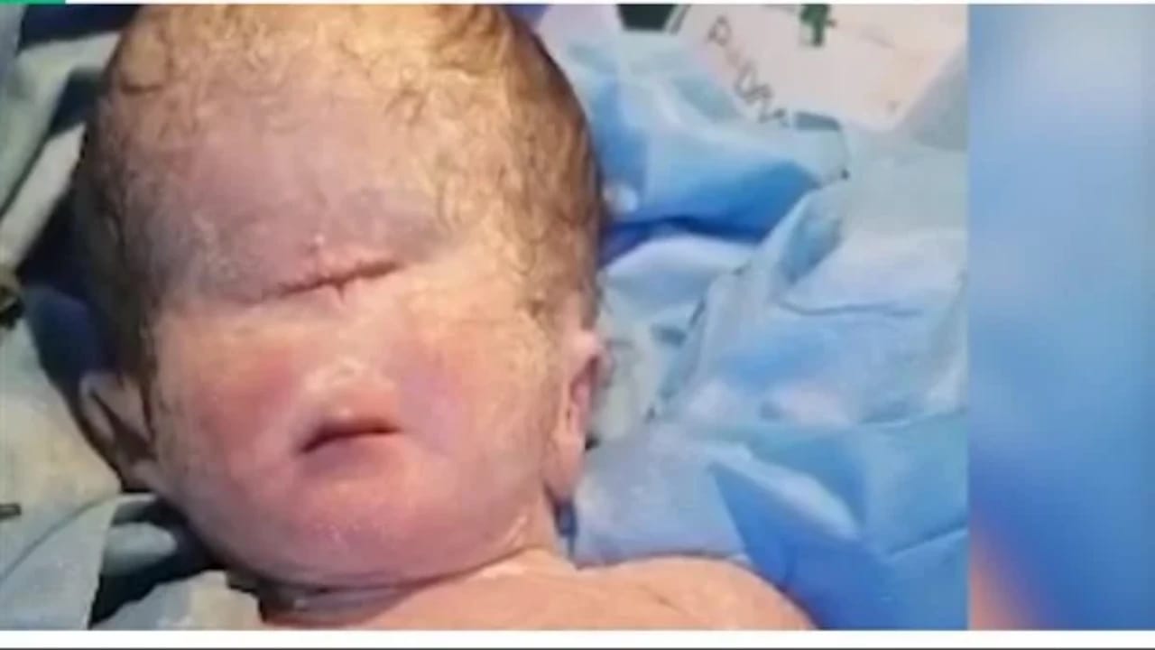 ولادة طفلة بعين واحدة في بلد عربي