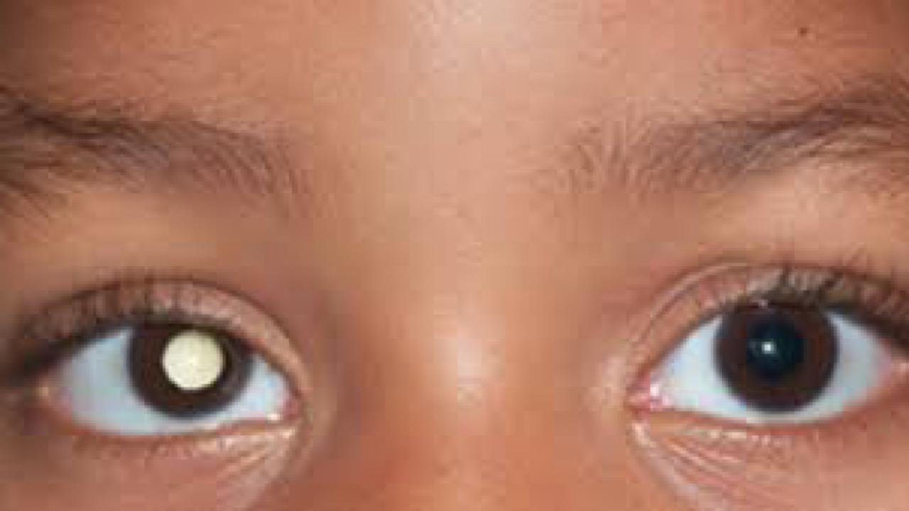 امرأة تكتشف إصابة طفلها بـ سرطان نادر من خلال عينيه