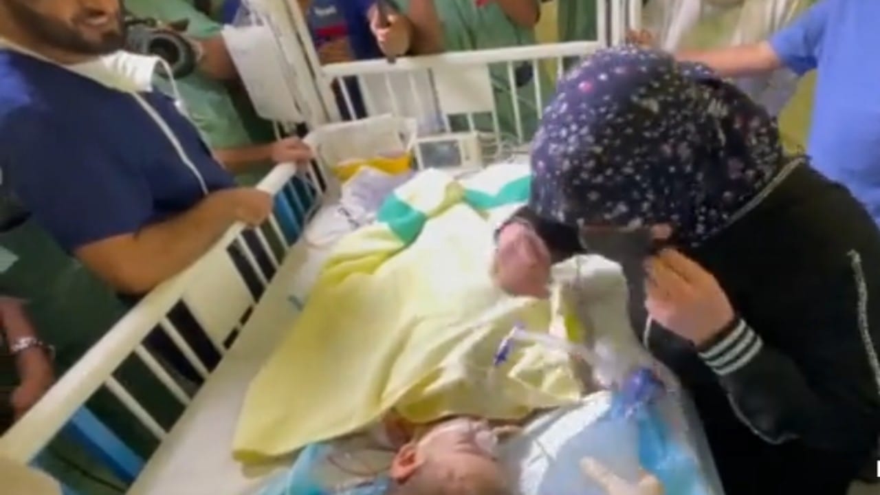 لحظة لقاء والدا التوأم السيامي بأحد الطفلين بعد انتهاء العملية.. فيديو