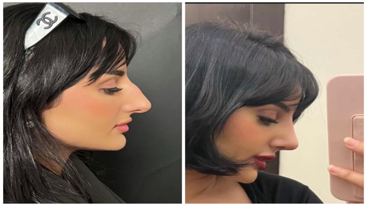 ميار اليافعي تشارك صورا لشكل أنفها بعد عملية التجميل