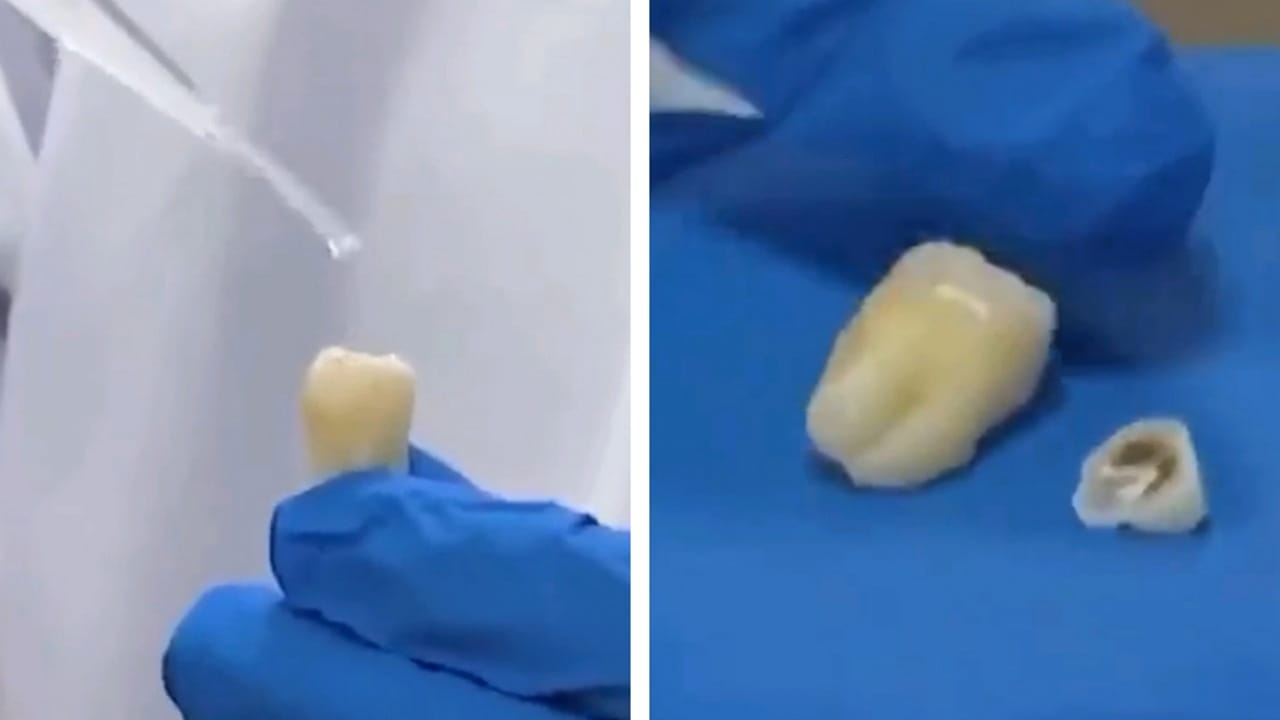 اختراع صيني يعيد الأسنان التالفة لطبيعتها..فيديو