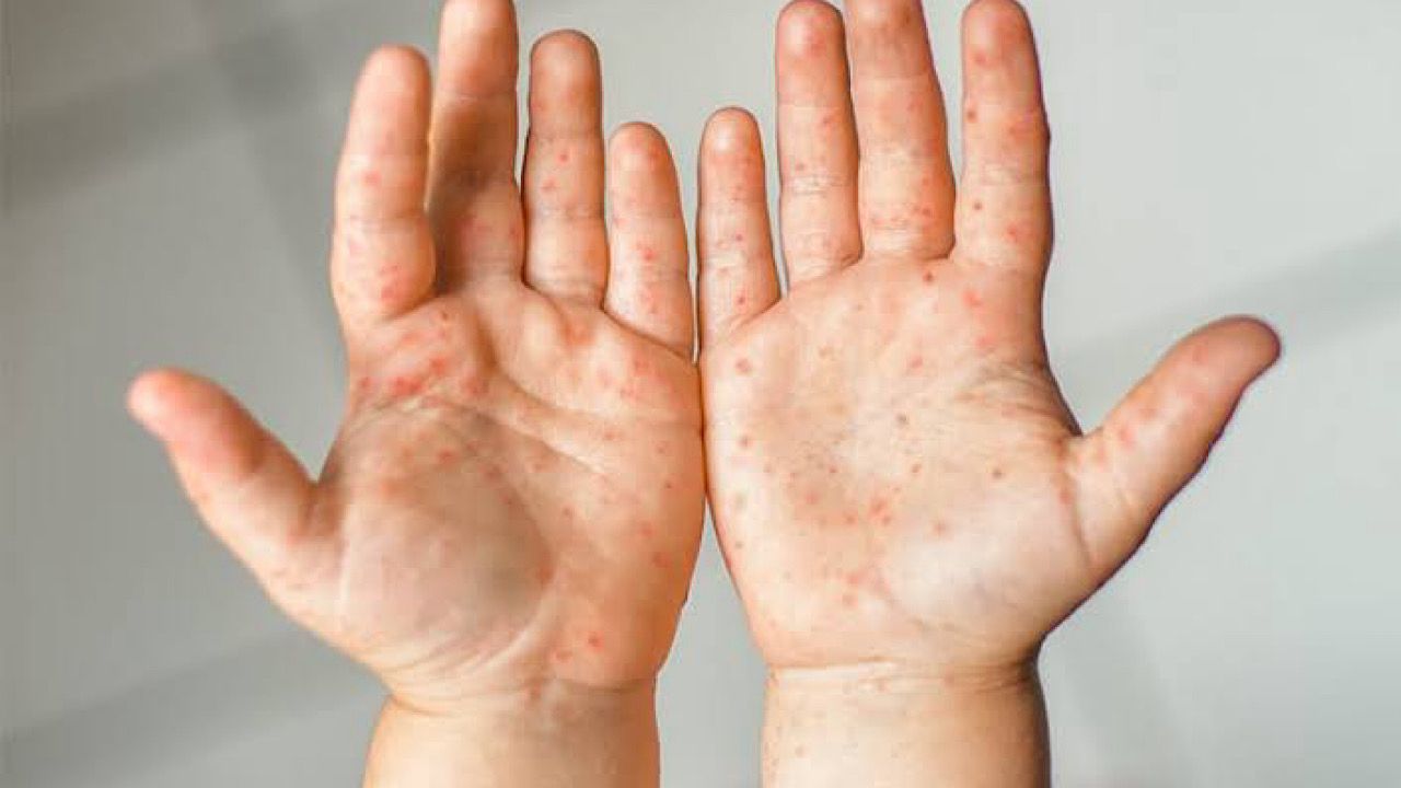 استشاري جلدية يوضح ما هو فيروس متلازما اليد والأقدام وأعراضه .. فيديو