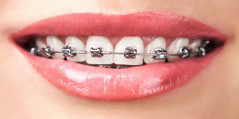 طبيب : تقويم الأسنان قد يسبب التسوس والتقرحات .. فيديو