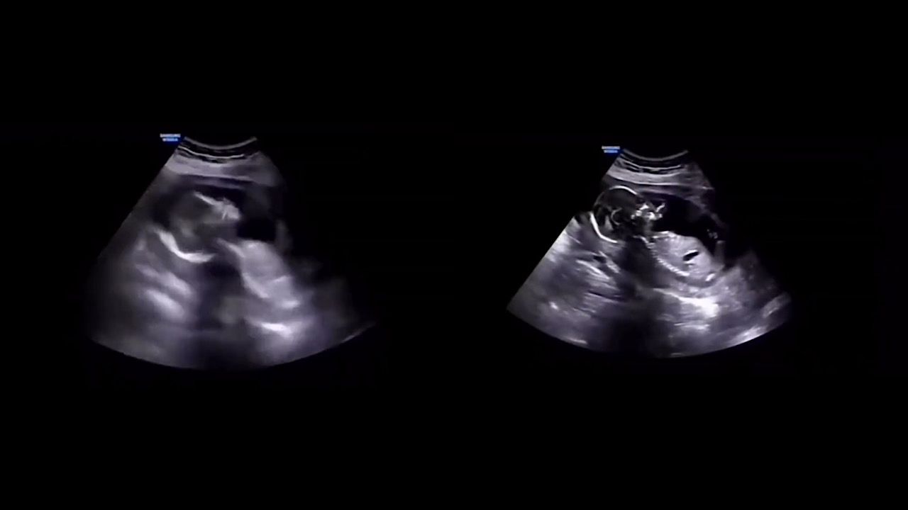 مقطع فيديو يكشف الذي يحدث للجنين عندما تضحك الأم .. فيديو