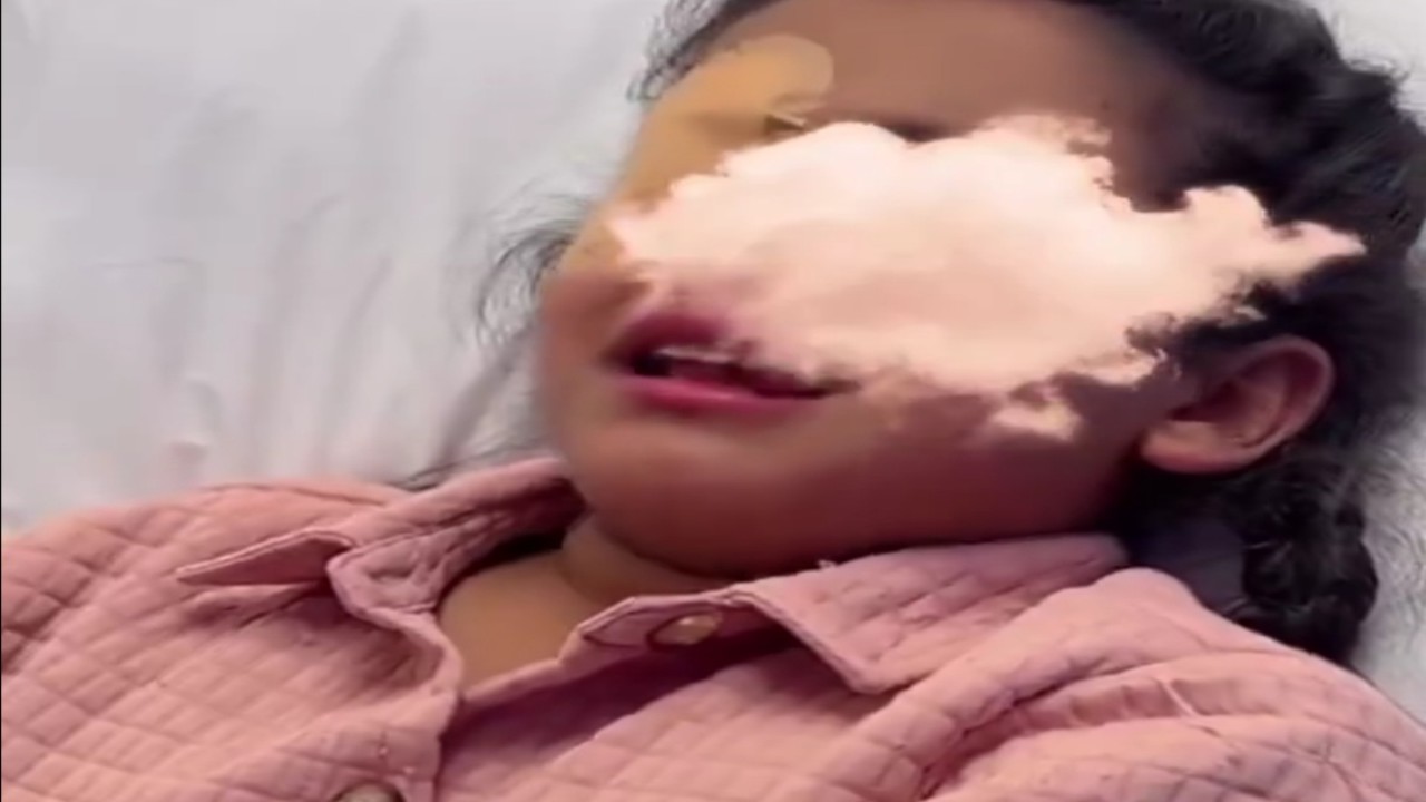 مشهد مؤثر لطفلة تعرضت لخدش خطير في عينها بسبب قطة .. فيديو