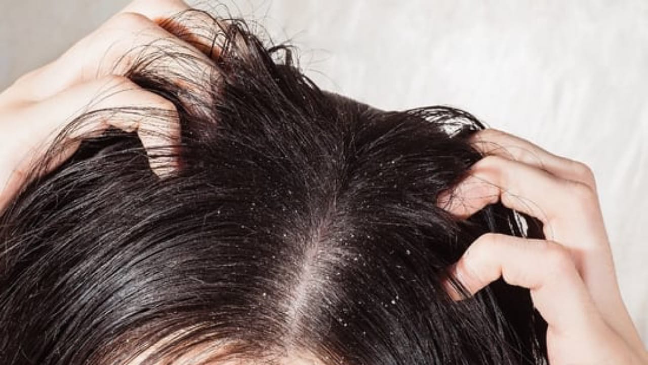 أسباب ظهور قشرة الشعر وطرق التخلص والوقاية منها