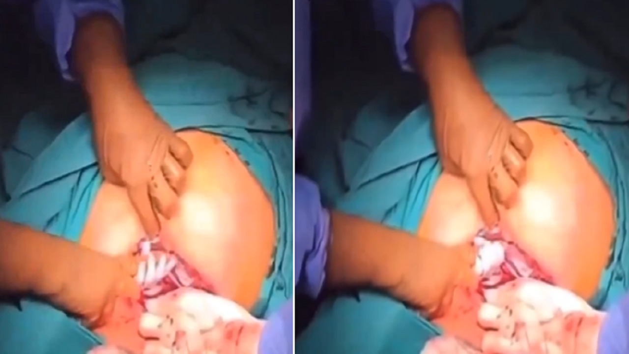 لقطة طريفة لمولود يمسك بيد الطبيب لحظة إخراجه من بطن أمه .. فيديو