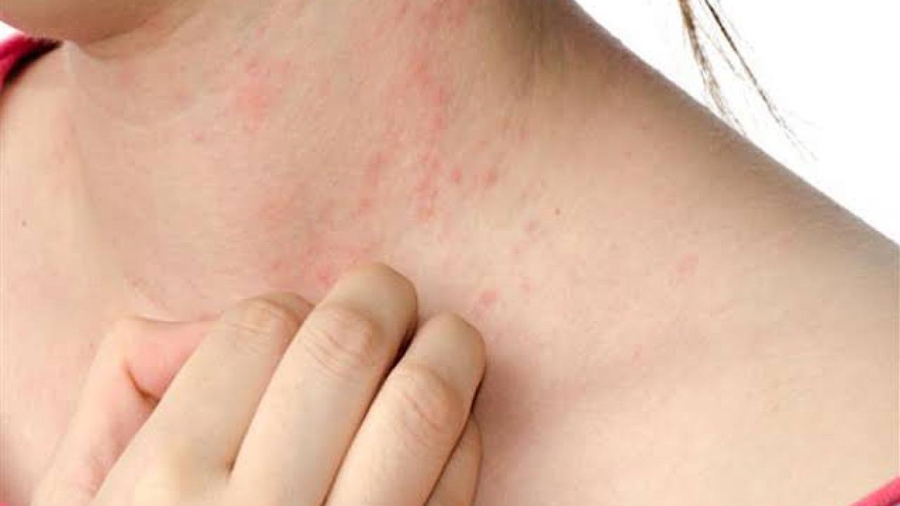 علامات على الجلد تشير لإصابتك بمرض خطير