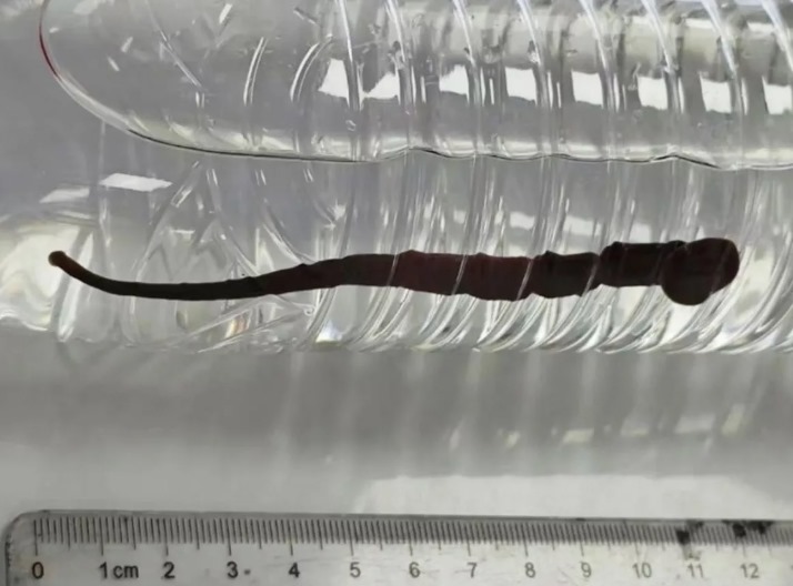 كائن حي يخرج من فم طفل يعاني من السعال.. فيديو