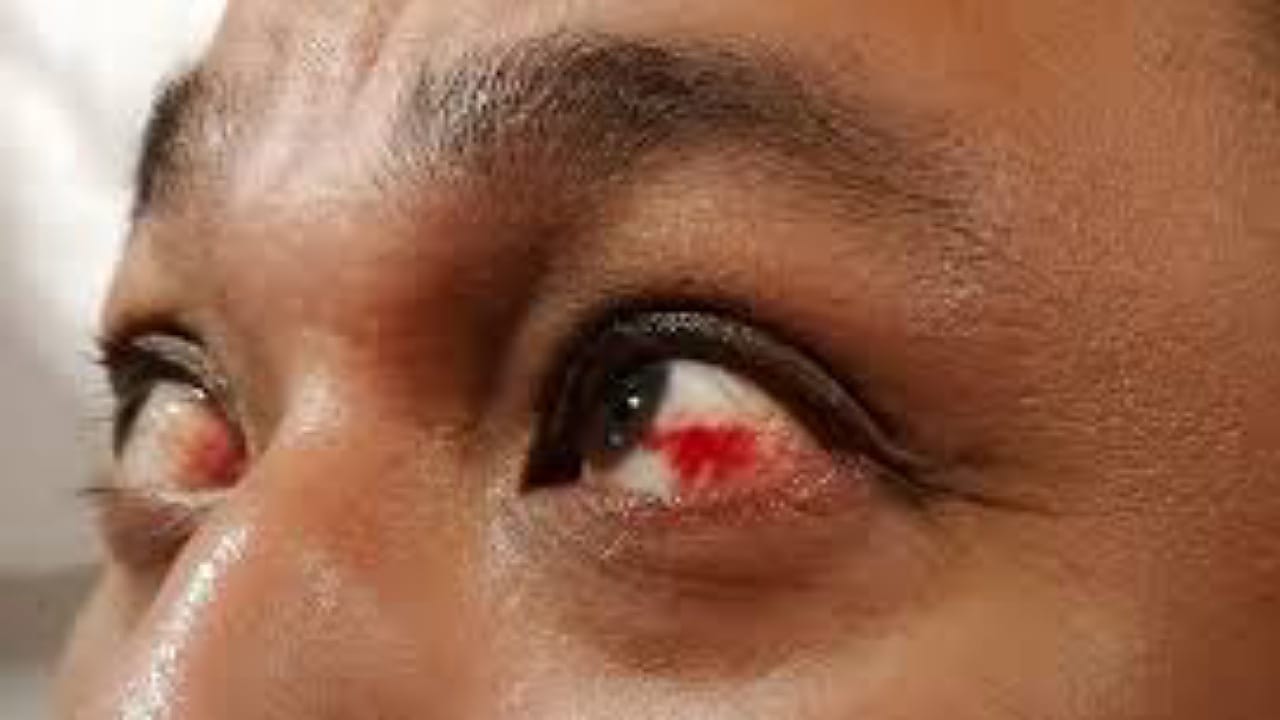 النمر يوضح أسباب نزيف تحت الملتحمة ويفند خرافات عن القهوة والضغط