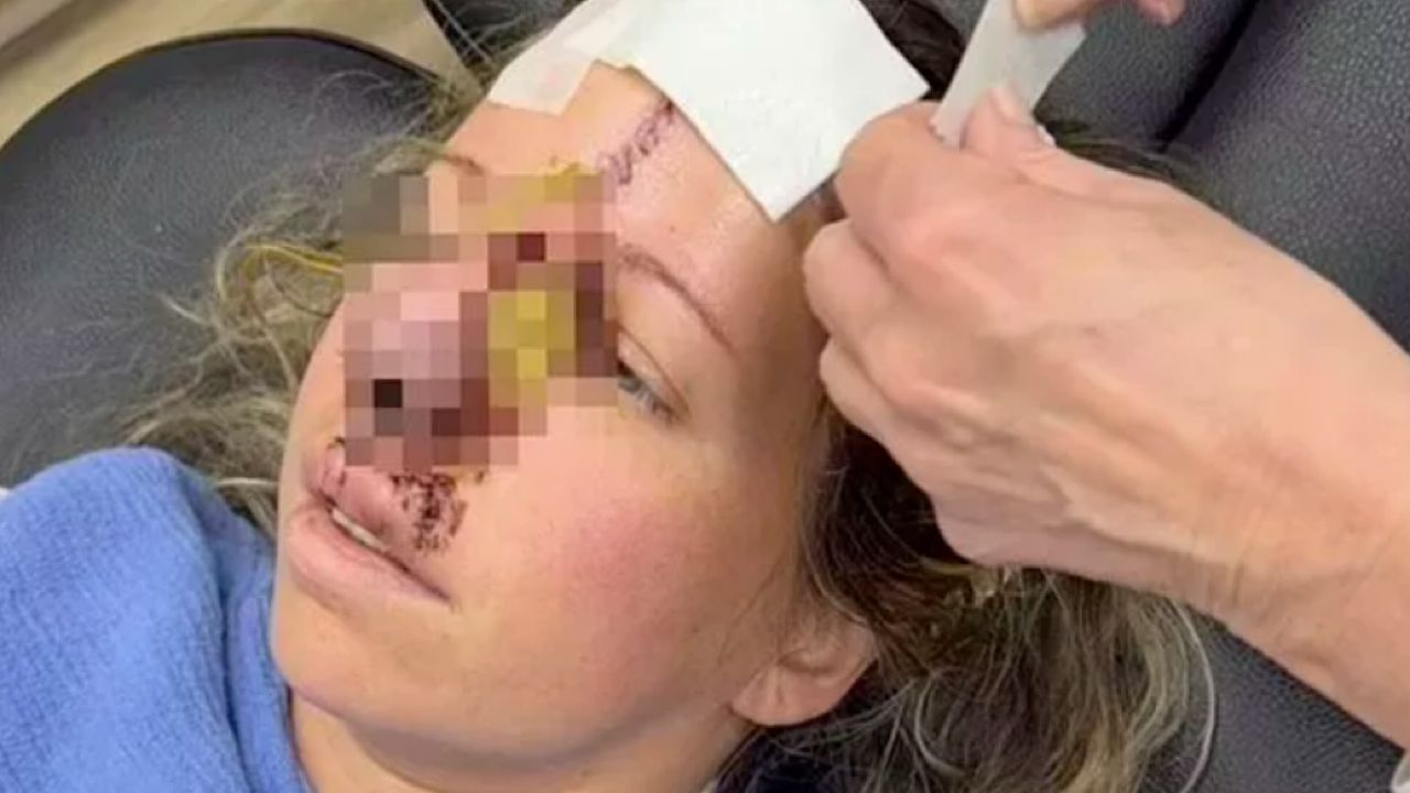 كلب يقضم أنف صاحبته بعد أن ربته لمدة 11 عاما