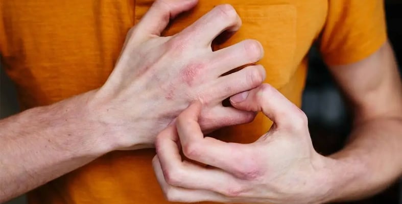 استشارية جلدية توصي بمنظفات ملابس أقل تهييجا لمصابي الإكزيما