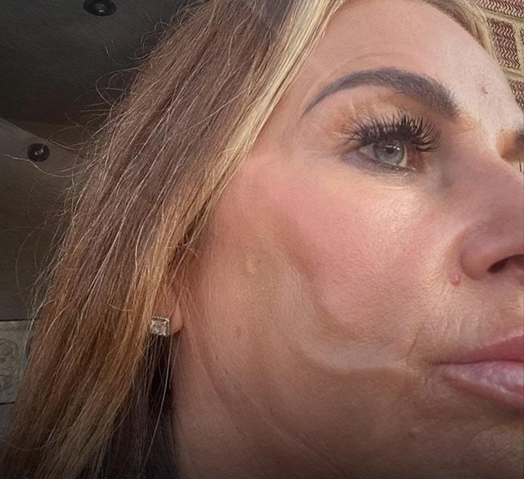 بريطانية تعاني تشوهات كارثية بعد عملية شد وجه .. صور