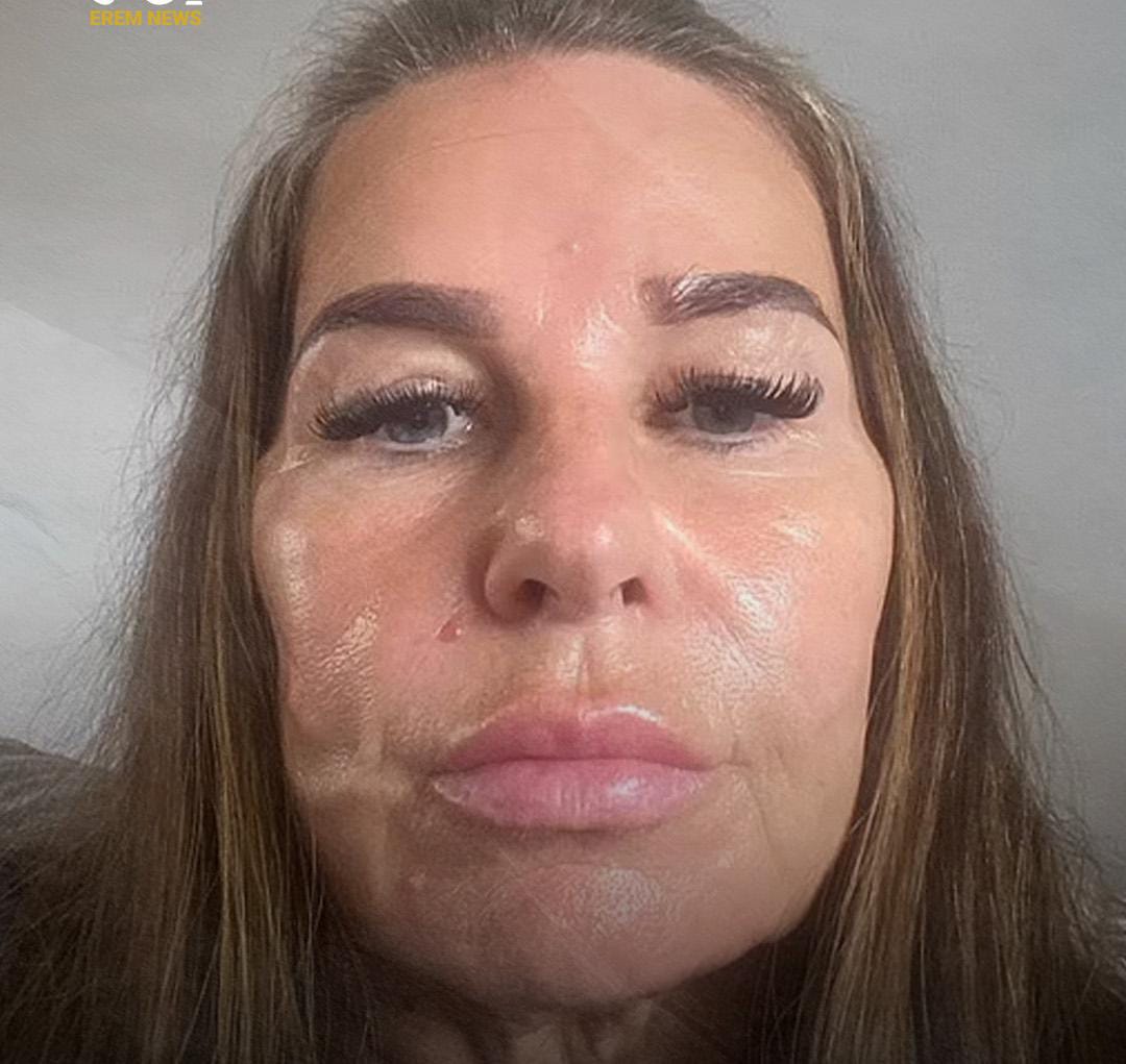 بريطانية تعاني تشوهات كارثية بعد عملية شد وجه .. صور