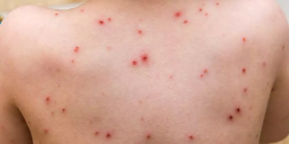 أعراض الإصابة بالسلالة الجديدة من جدري القرود