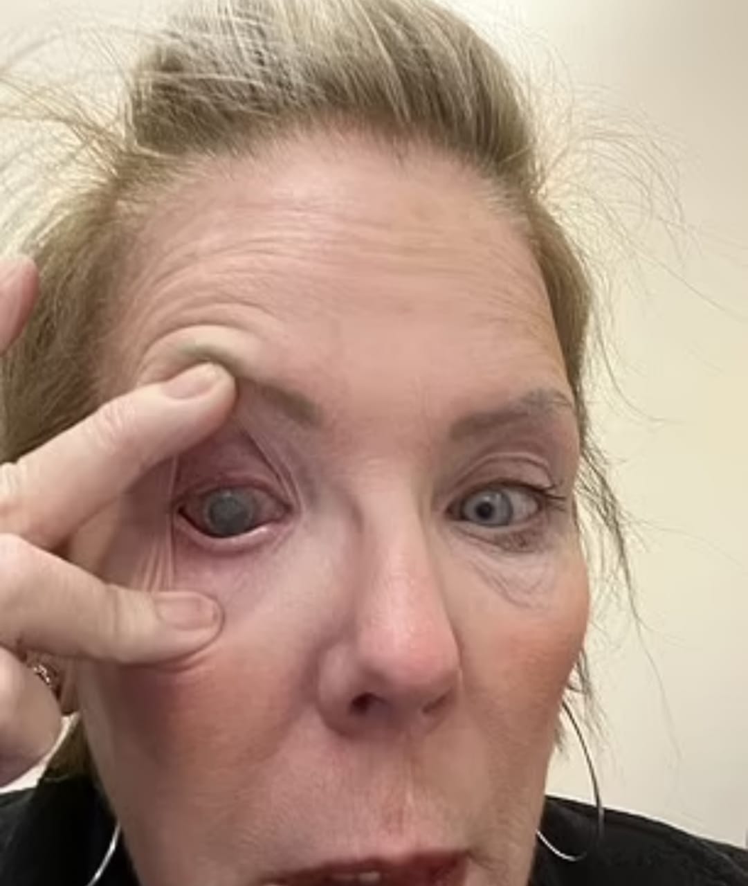 امرأة تفقد بصرها بسبب العدسات اللاصقة ..صورة