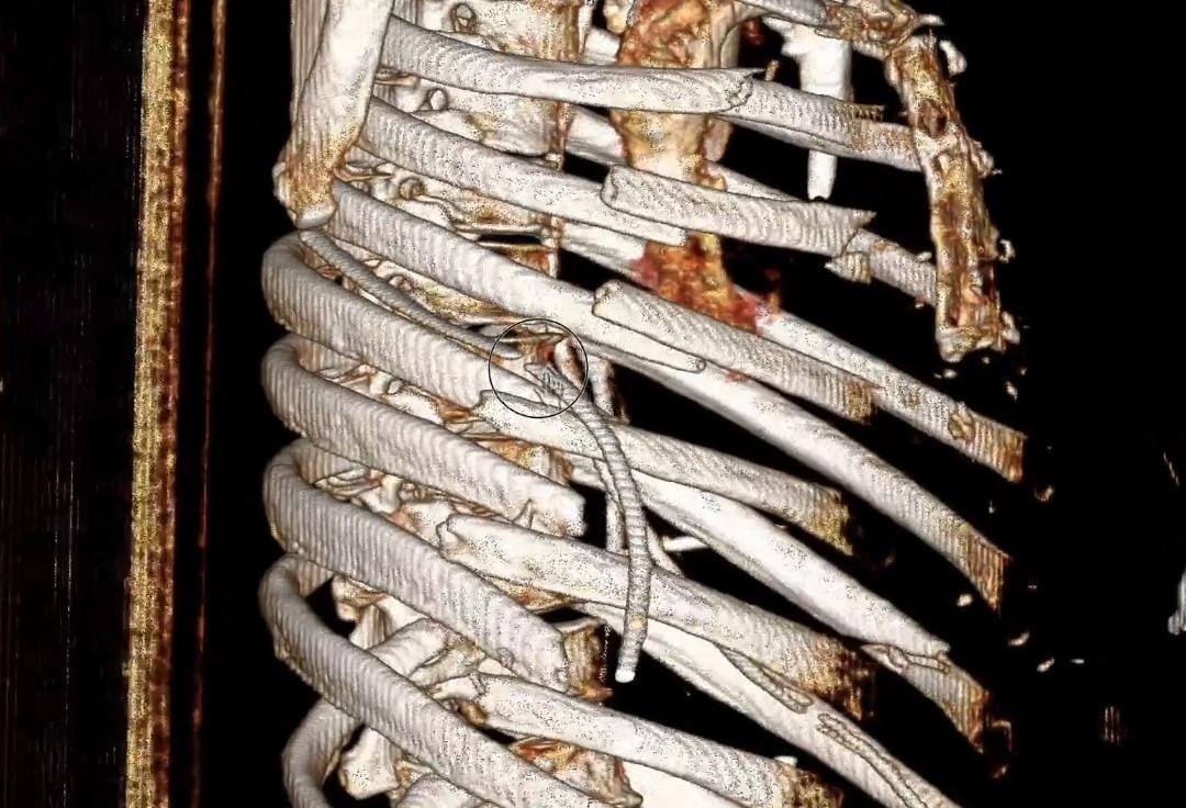 إصابات خطيرة لامرأة تكشف عواقب عدم ارتداء حزام الأمان.. صور