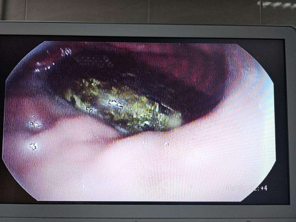 استخراج هاتف من معدة سجين بعد 6 سنوات من ابتلاعه .. صور