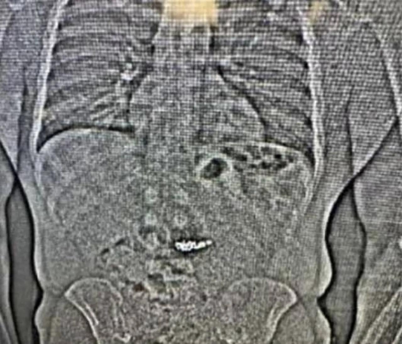 لص يبتلع أقراط ألماس بقيمة 770 ألف دولار