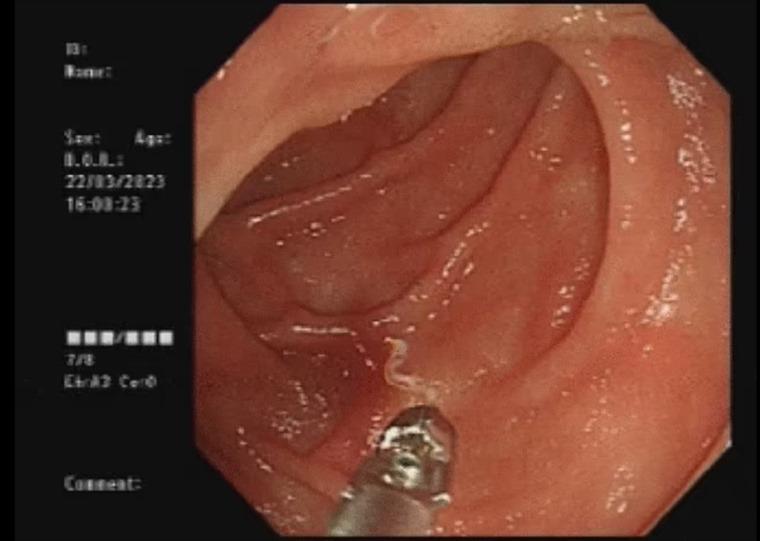  أطباء يكتشفون ديدانا مماصة للدماء في أمعاء امرأة