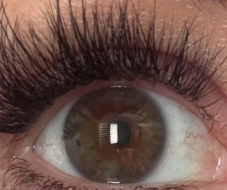 صاعقة برق تغير لون عيني شابة أسترالية بعد نجاتها بأعجوبة!