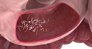  علامات تحذيرية خطيرة تدل على الإصابة بالديدان الخطافية والشريطية