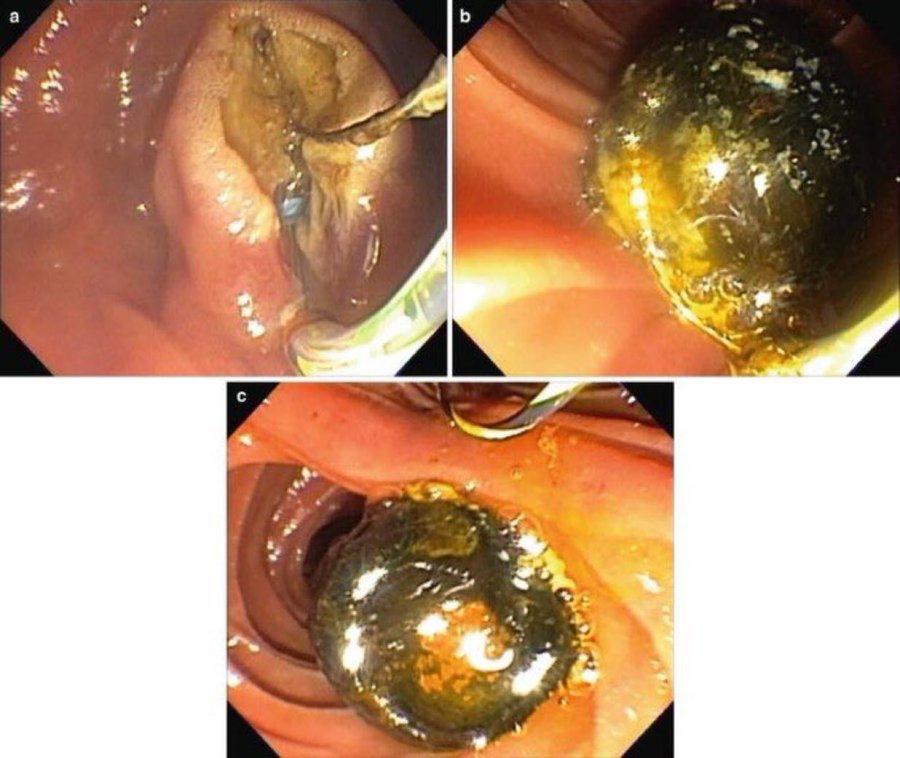مختص: حصوات القنوات المرارية تزال بالمنظار من الجسم
