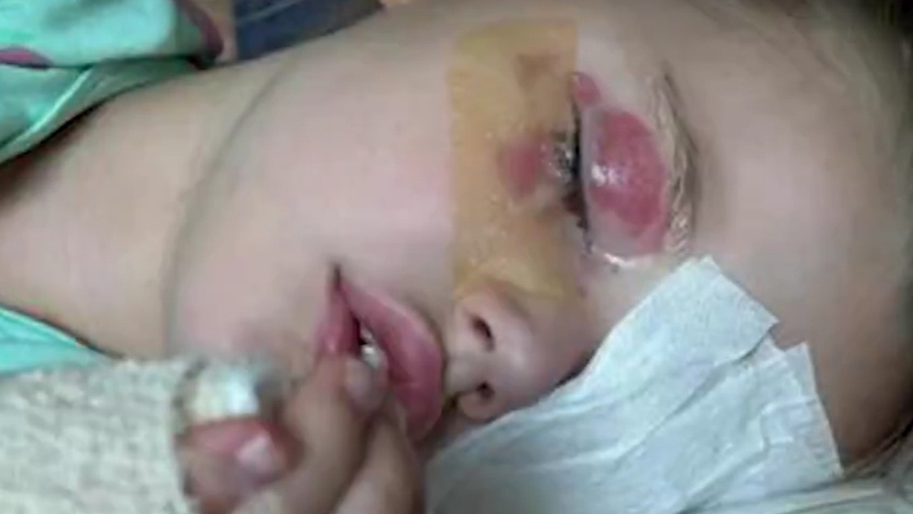 مسحوق غسيل يتسبب في فقد طفلة لبصرها