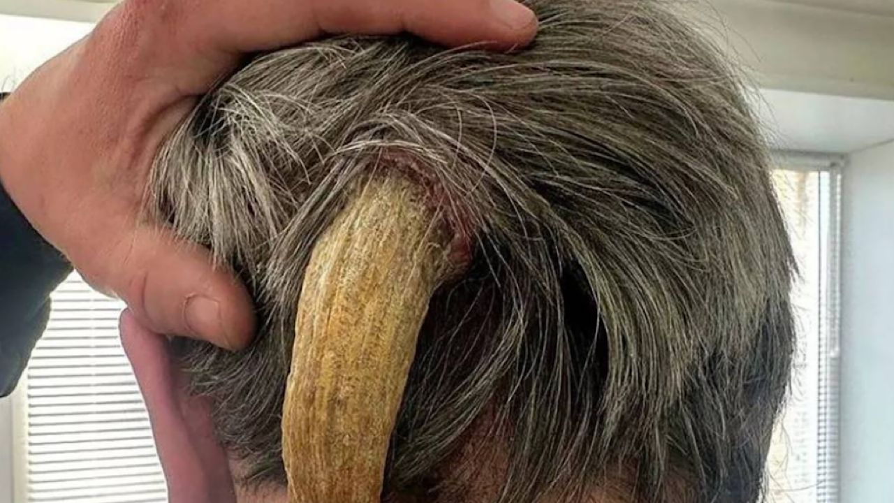 رجل يتخلص بنجاح من قرن عانى منه لمدة ثلاث سنوات
