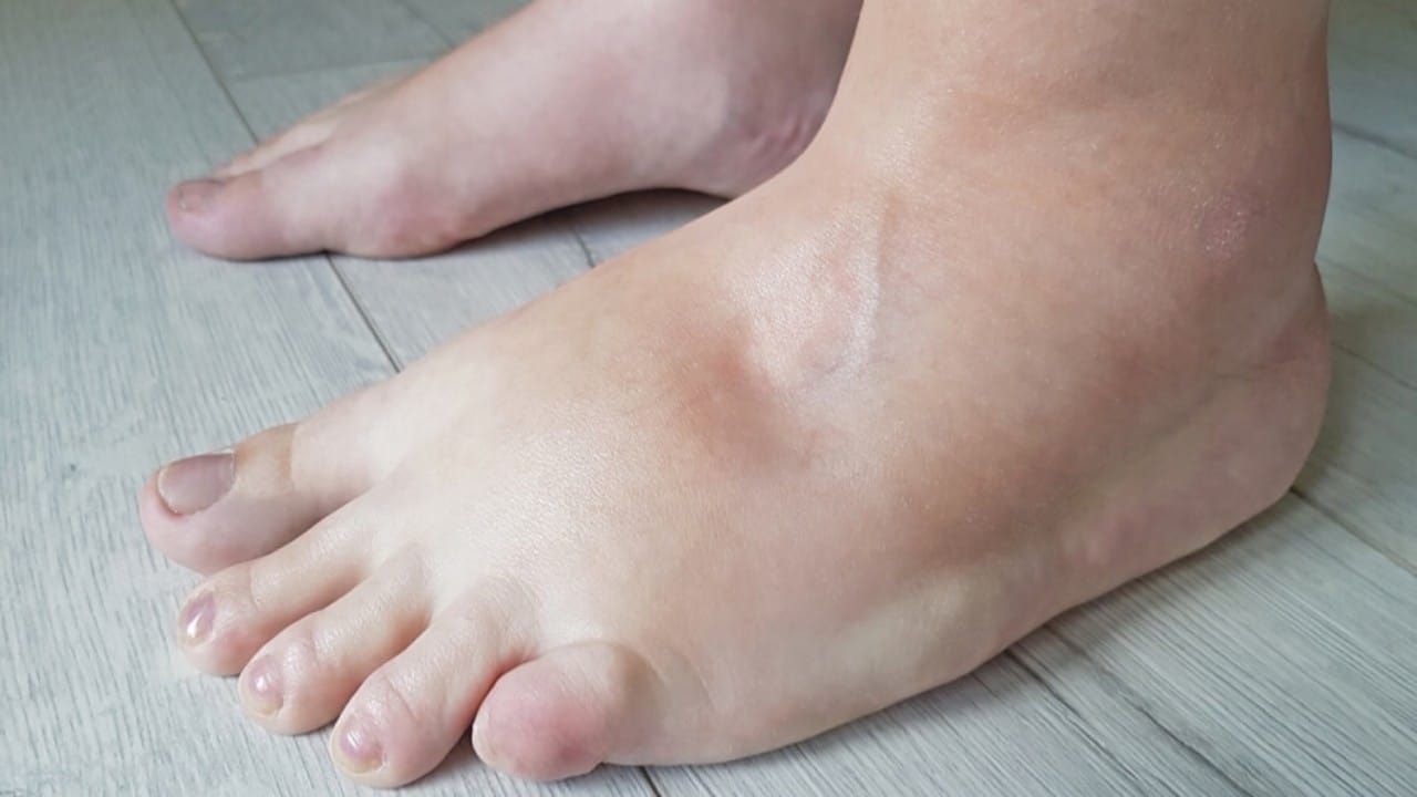 أسباب احتباس السوائل في الجسم وطرق مواجهته.. فيديو