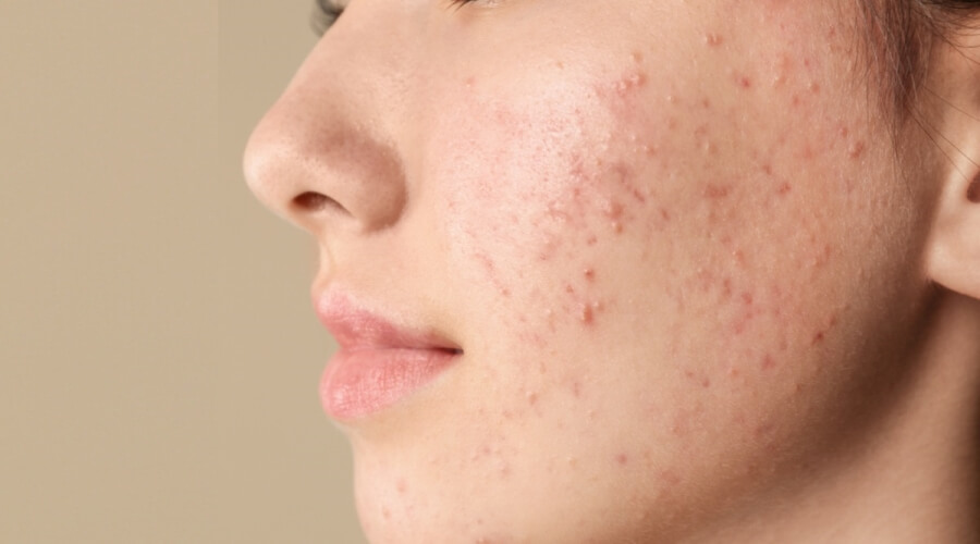 استشاري يكشف عن 4 أطعمة ترتبط بظهور حب الشباب .. فيديو