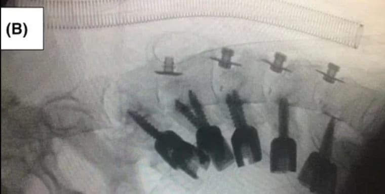 صور طبية لحالة نادرة لرجل سقط رأسه على صدره بسبب تعاطي المخدرات