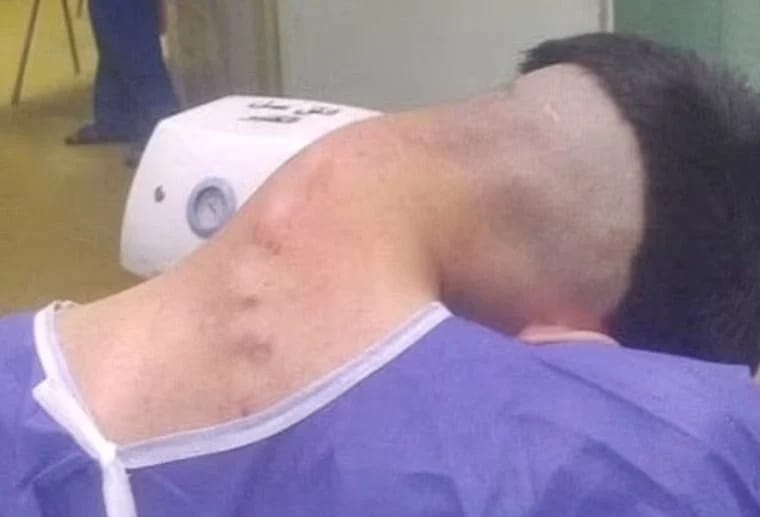 صور طبية لحالة نادرة لرجل سقط رأسه على صدره بسبب تعاطي المخدرات