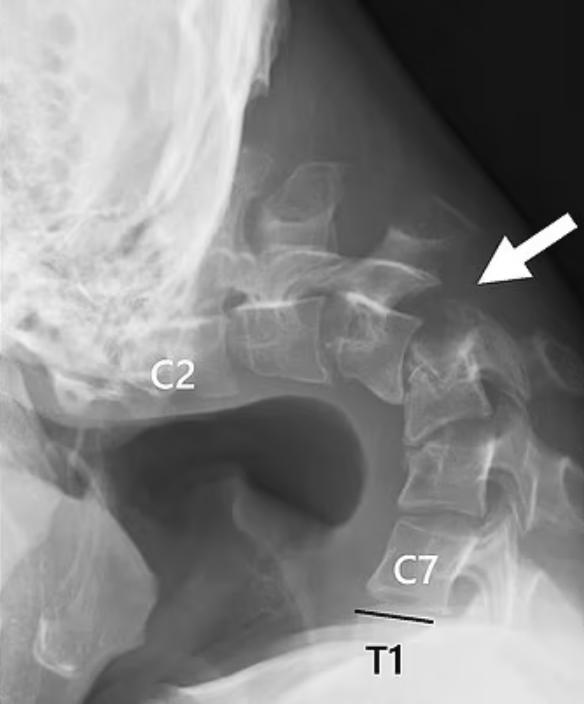 إصابة شاب بمتلازمة الرأس المتدلي بسبب الجوال